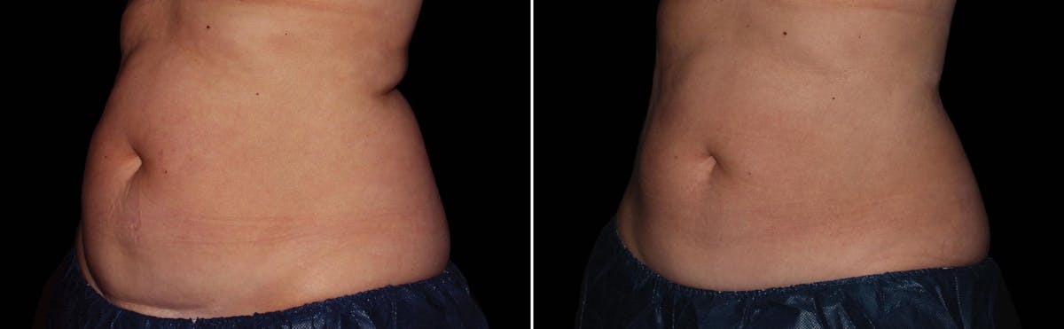 CoolSculpting Before & After Gallery - Patient 122405517 - Image 1
