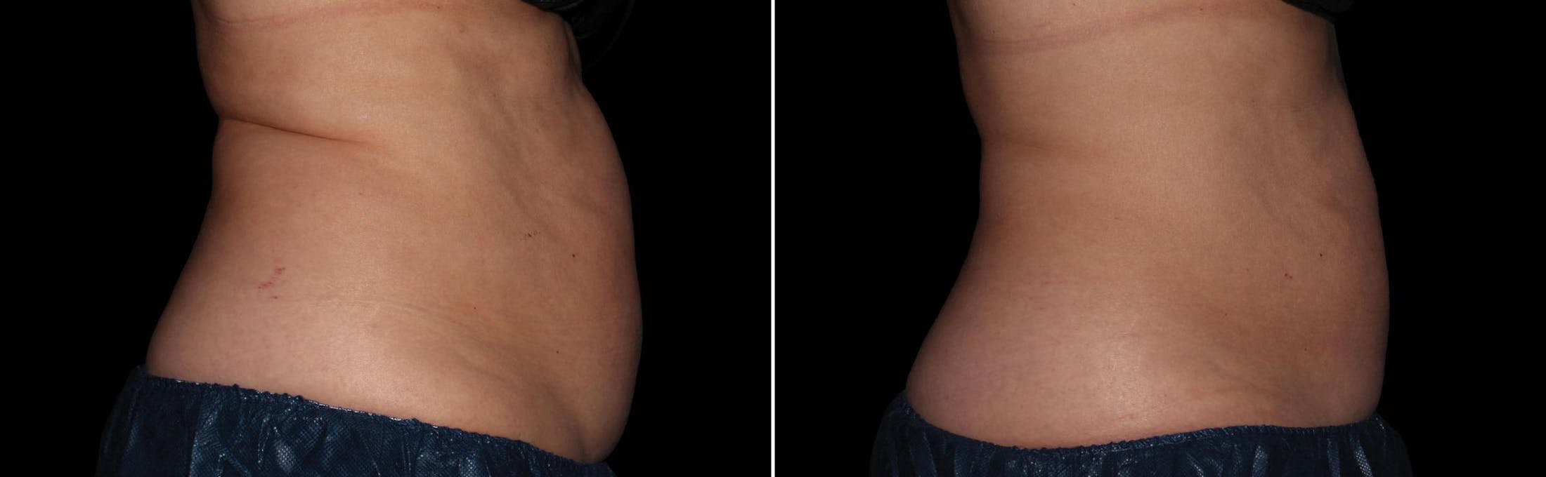 CoolSculpting Before & After Gallery - Patient 122405517 - Image 2