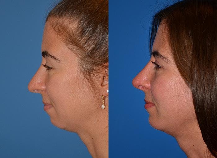 Chin Augmentation Before & After Gallery - Patient 122405519 - Image 1