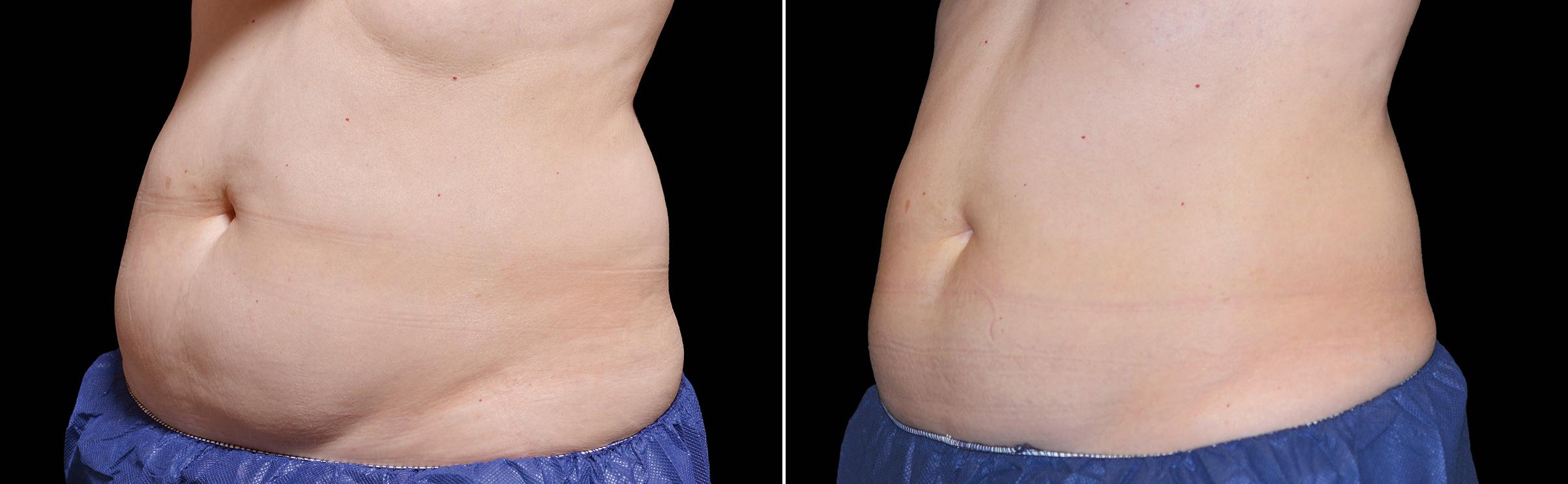 CoolSculpting Before & After Gallery - Patient 352025 - Image 1
