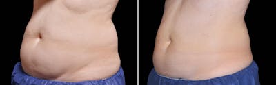 CoolSculpting Before & After Gallery - Patient 122405518 - Image 1