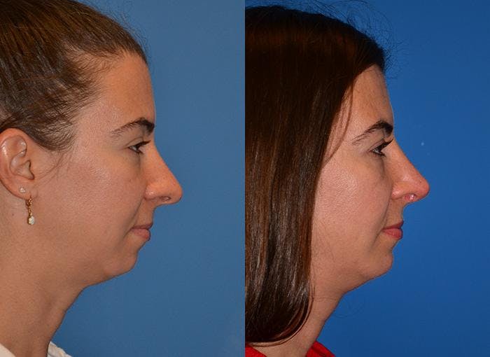 Chin Augmentation Before & After Gallery - Patient 122405519 - Image 2