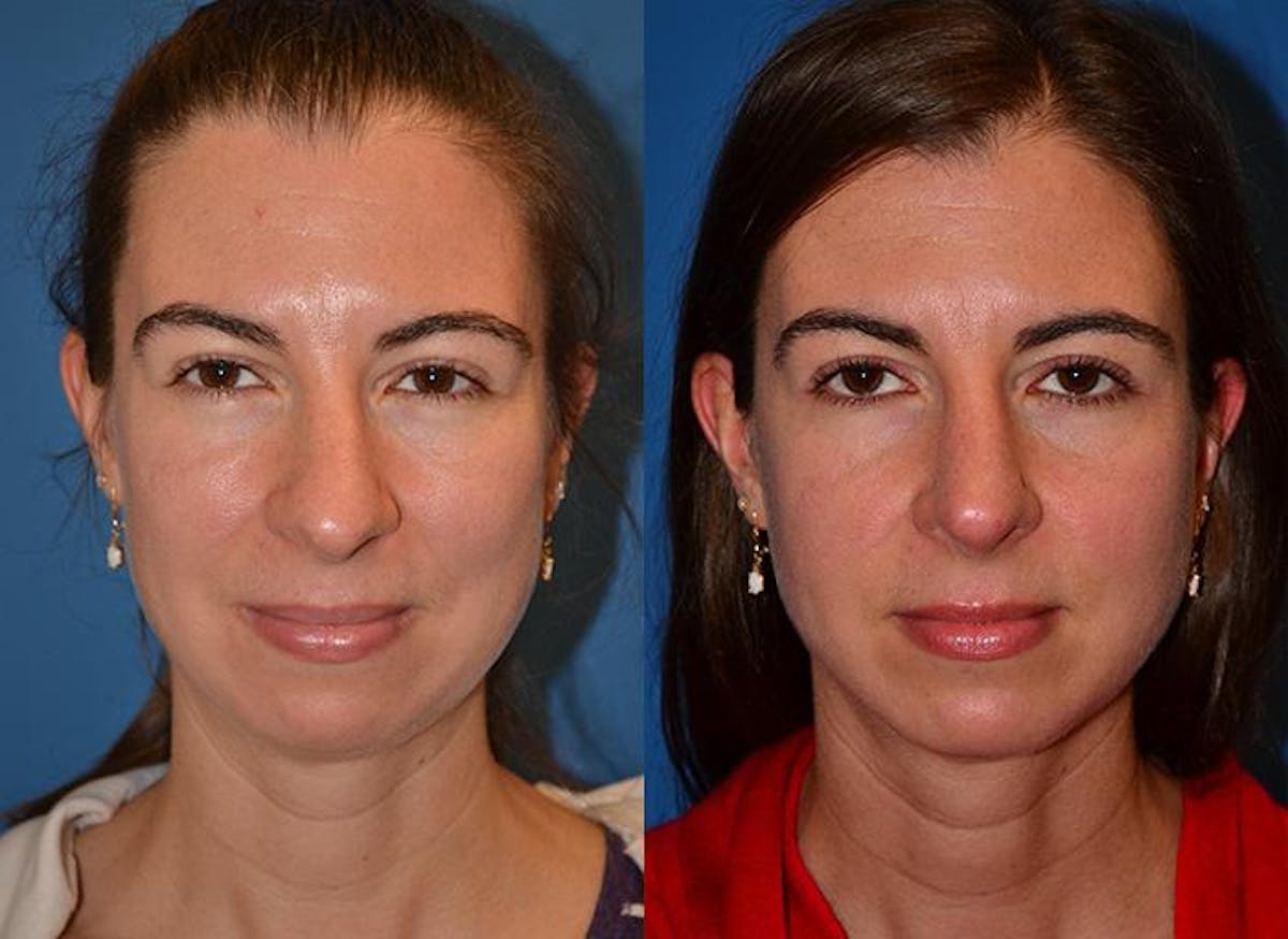 Chin Augmentation Before & After Gallery - Patient 122405519 - Image 3