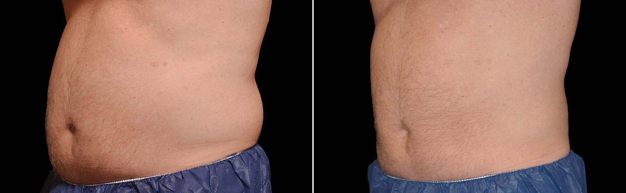 CoolSculpting Before & After Gallery - Patient 370852 - Image 1