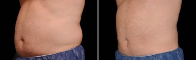 CoolSculpting Before & After Gallery - Patient 122405521 - Image 1