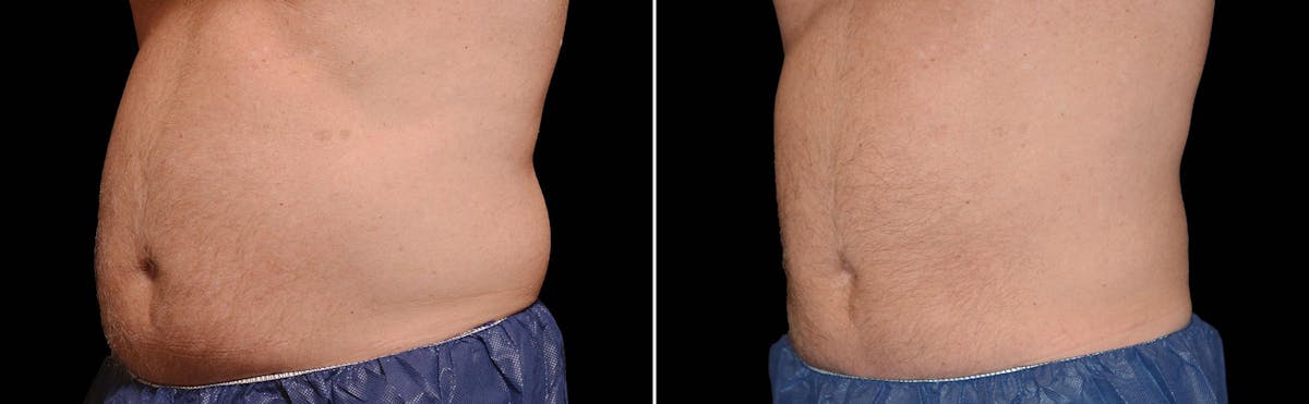 CoolSculpting Before & After Gallery - Patient 122405521 - Image 1
