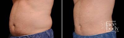 CoolSculpting Before & After Gallery - Patient 370852 - Image 1
