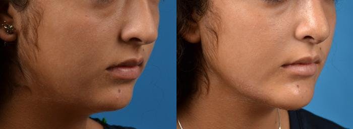 Chin Augmentation Before & After Gallery - Patient 122405522 - Image 1