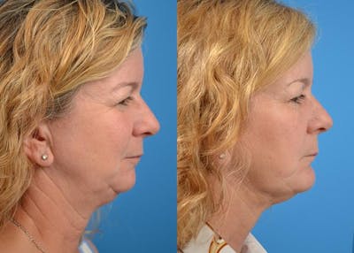 Chin Augmentation Before & After Gallery - Patient 122405527 - Image 1