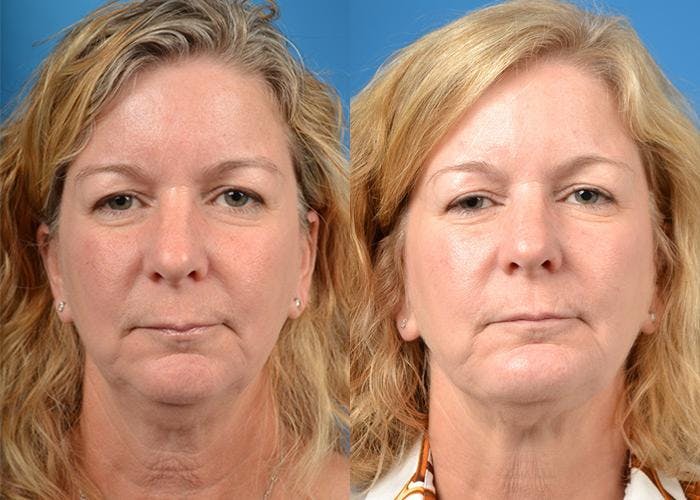 Chin Augmentation Before & After Gallery - Patient 122405527 - Image 3
