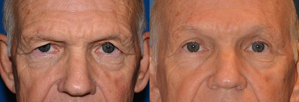 Brow Lift Before & After Gallery - Patient 122405528 - Image 2