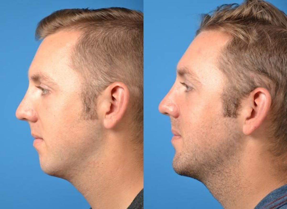 Chin Augmentation Before & After Gallery - Patient 122405530 - Image 1