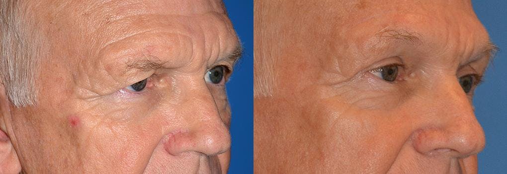 Brow Lift Before & After Gallery - Patient 122405528 - Image 3
