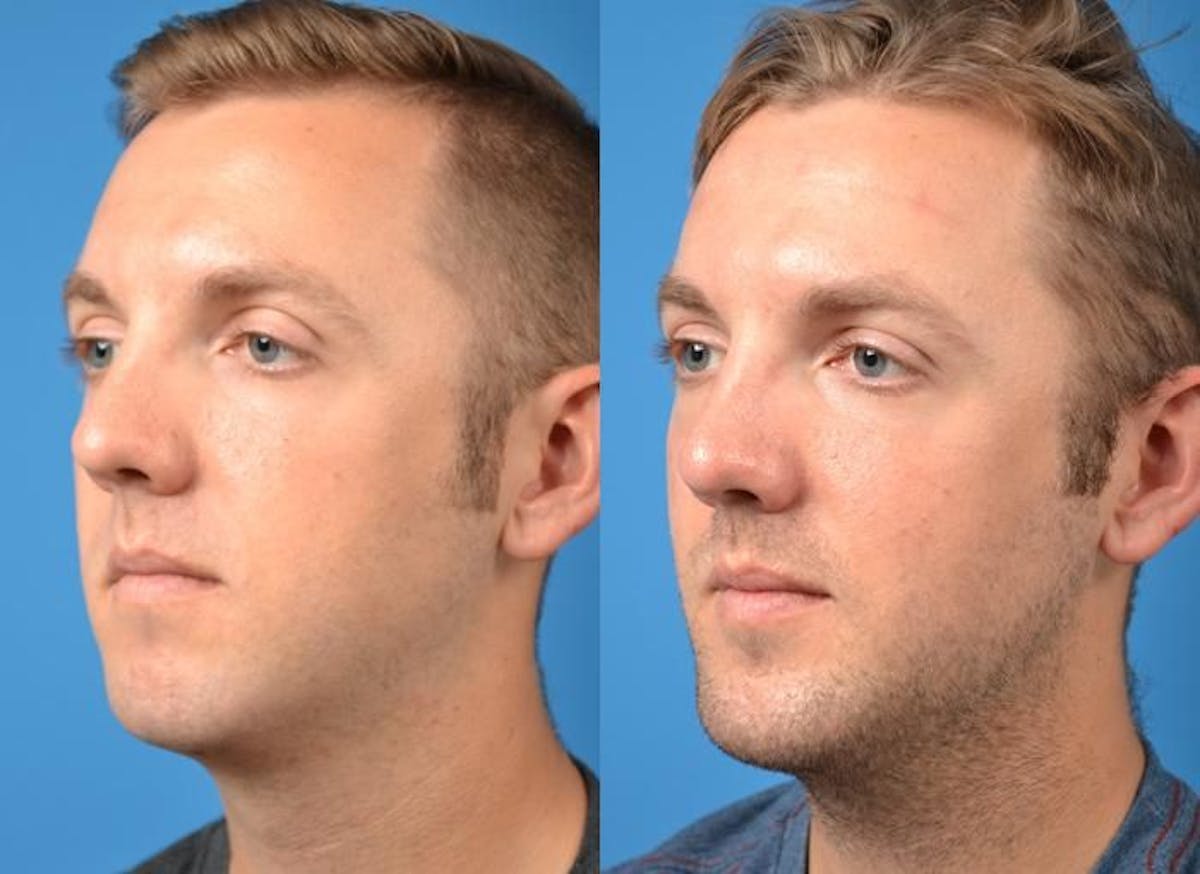 Chin Augmentation Before & After Gallery - Patient 122405530 - Image 2