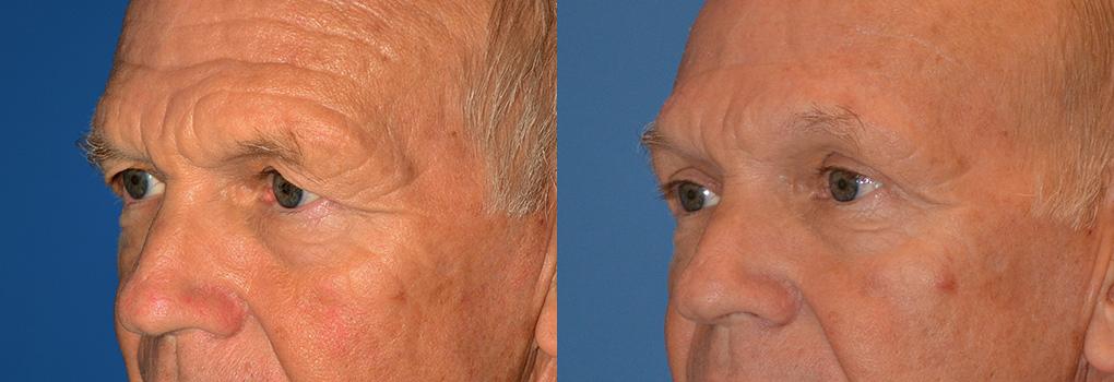 Brow Lift Before & After Gallery - Patient 122405528 - Image 4