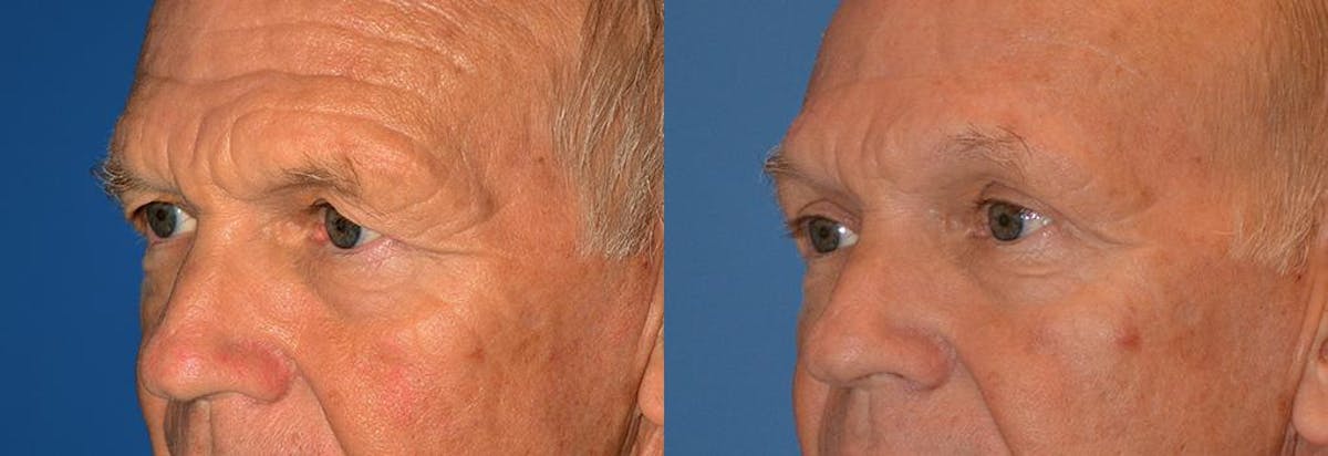 Brow Lift Before & After Gallery - Patient 122405528 - Image 4