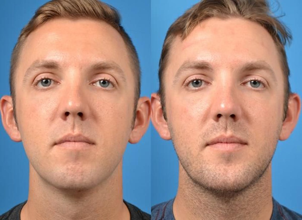 Chin Augmentation Before & After Gallery - Patient 122405530 - Image 3