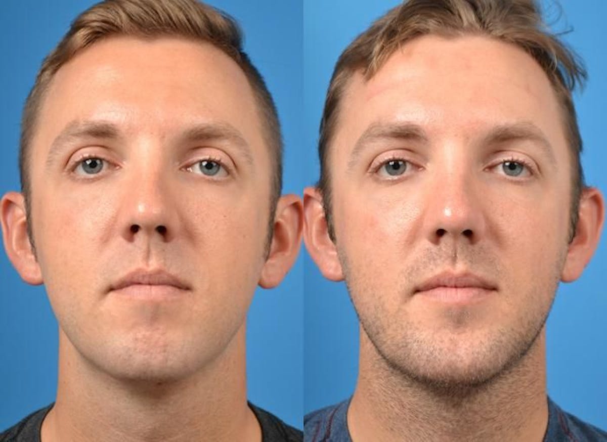 Chin Augmentation Before & After Gallery - Patient 122405530 - Image 3