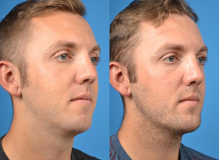 Chin Augmentation Before & After Gallery - Patient 122405530 - Image 4