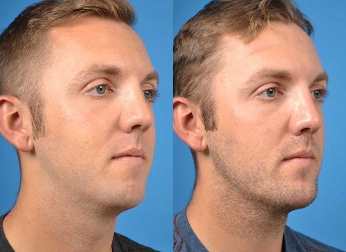 Chin Augmentation Before & After Gallery - Patient 122405530 - Image 4