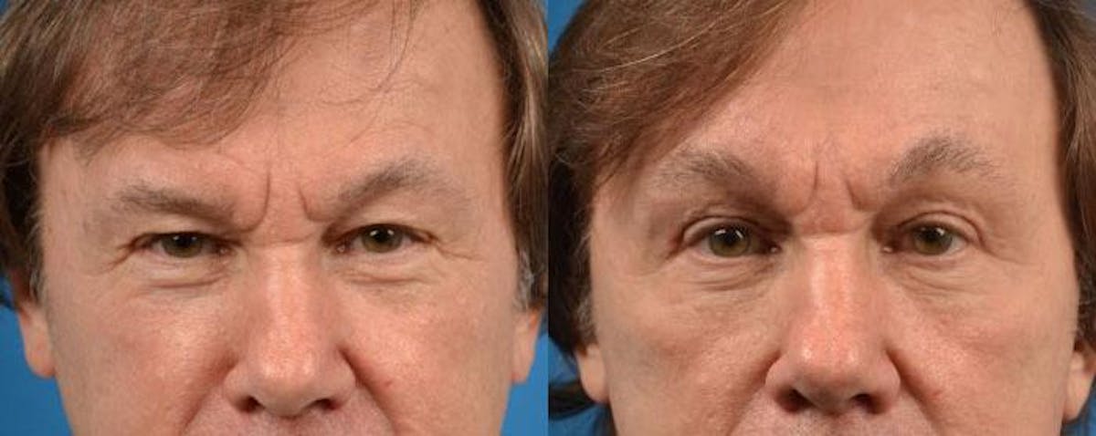 Brow Lift Before & After Gallery - Patient 122405532 - Image 1