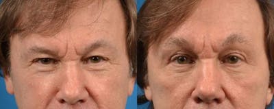 Brow Lift Before & After Gallery - Patient 122405532 - Image 1
