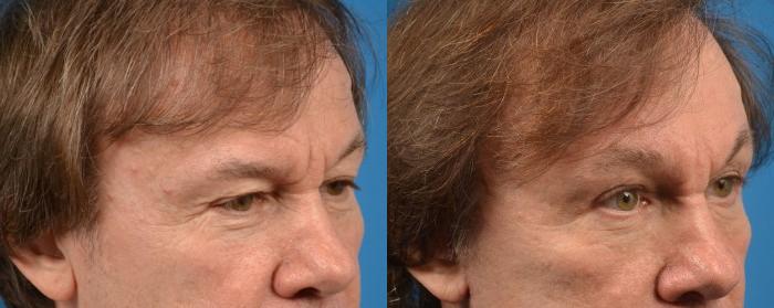 Brow Lift Before & After Gallery - Patient 122405532 - Image 2