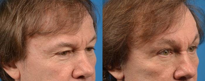 Brow Lift Before & After Gallery - Patient 122405532 - Image 2