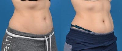 CoolTone Before & After Gallery - Patient 122405533 - Image 1
