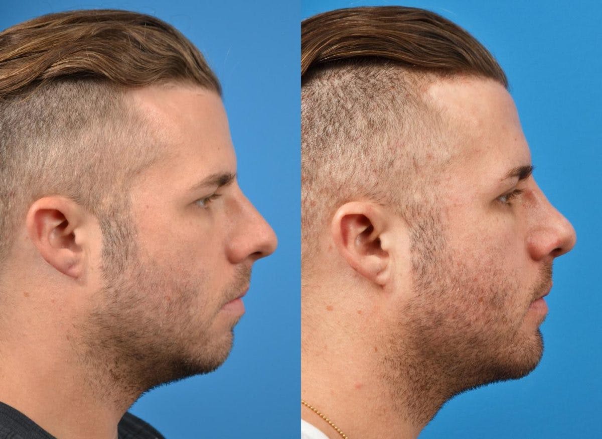 Chin Augmentation Before & After Gallery - Patient 122405534 - Image 1