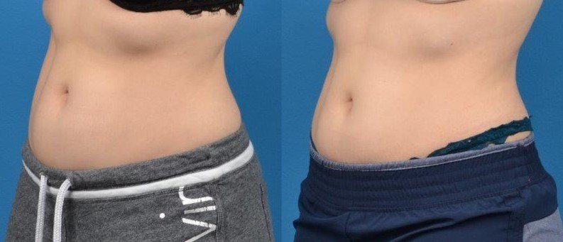 CoolTone Before & After Gallery - Patient 122405533 - Image 2