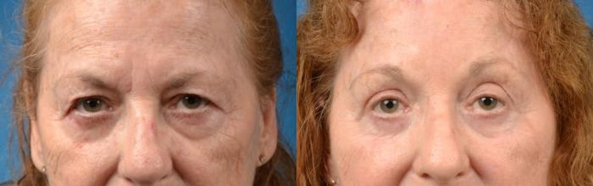 Brow Lift Before & After Gallery - Patient 122405535 - Image 1