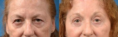 Brow Lift Before & After Gallery - Patient 122405535 - Image 1