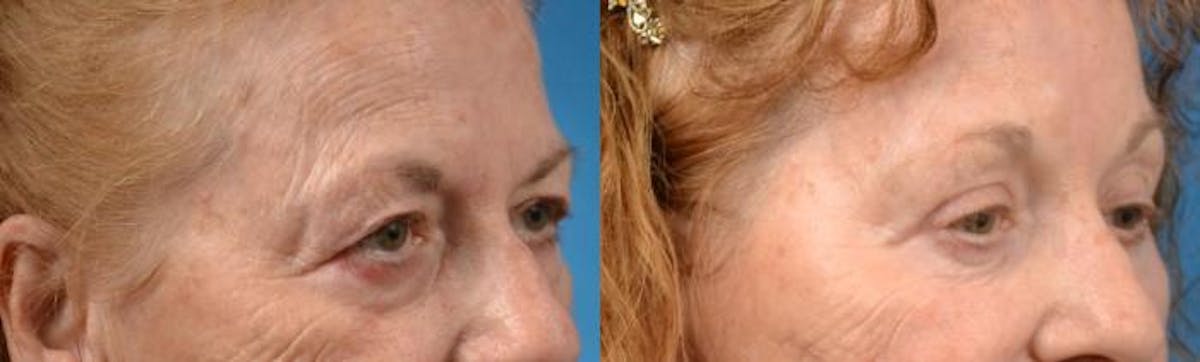 Brow Lift Before & After Gallery - Patient 122405535 - Image 2