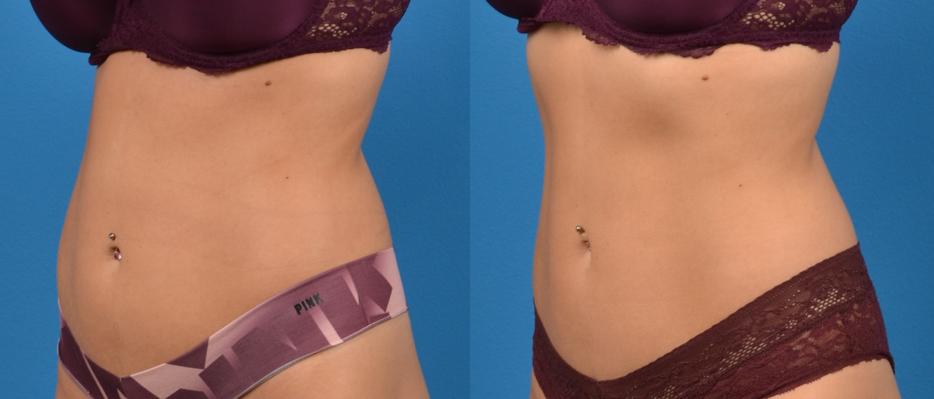 CoolTone Before & After Gallery - Patient 122405540 - Image 1