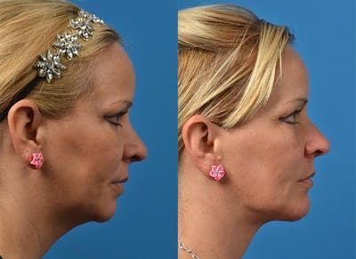Chin Augmentation Before & After Gallery - Patient 122405538 - Image 1