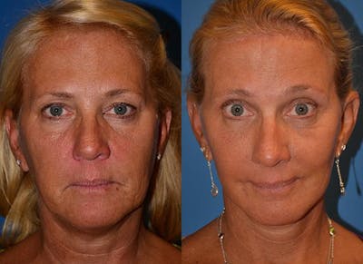 Brow Lift Before & After Gallery - Patient 122405539 - Image 1