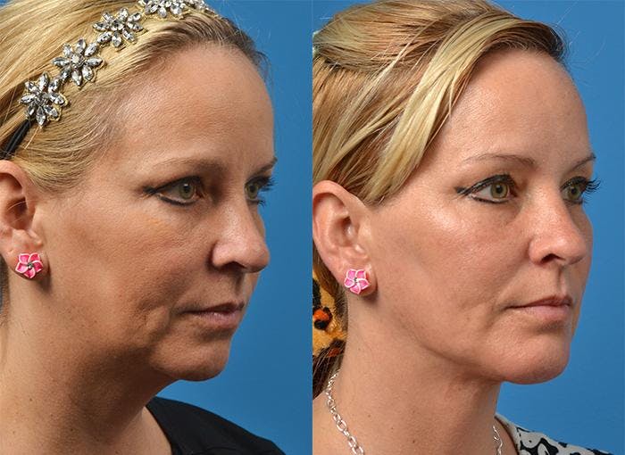 Chin Augmentation Before & After Gallery - Patient 122405538 - Image 2