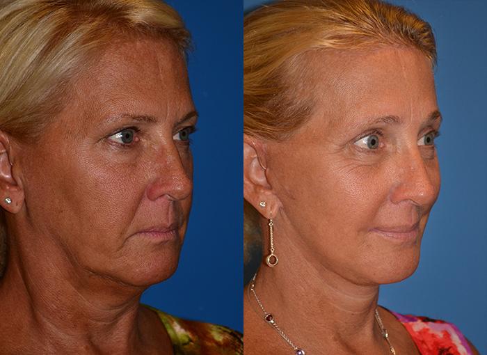Brow Lift Before & After Gallery - Patient 122405539 - Image 2