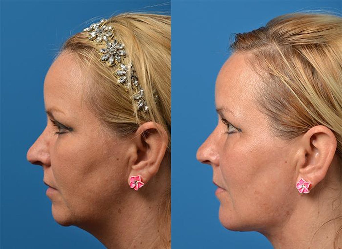 Chin Augmentation Before & After Gallery - Patient 122405538 - Image 3