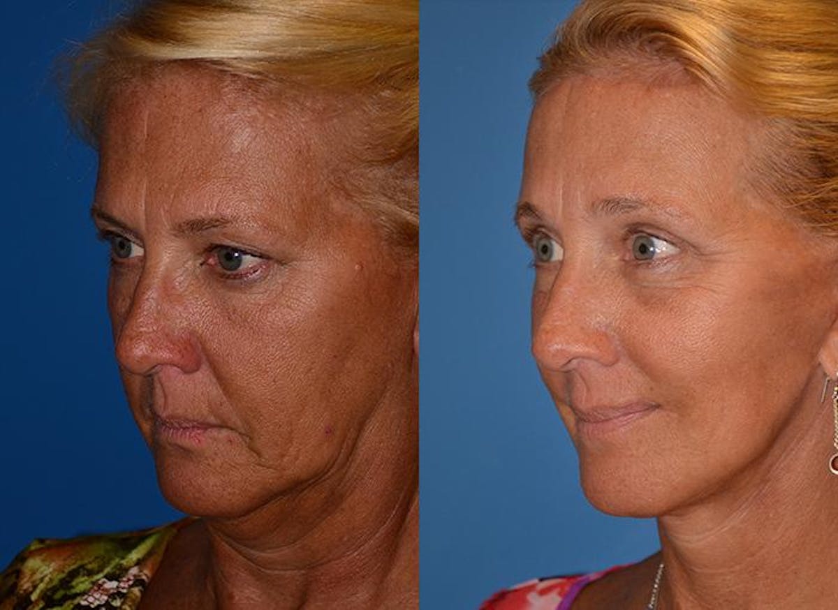 Brow Lift Before & After Gallery - Patient 122405539 - Image 3