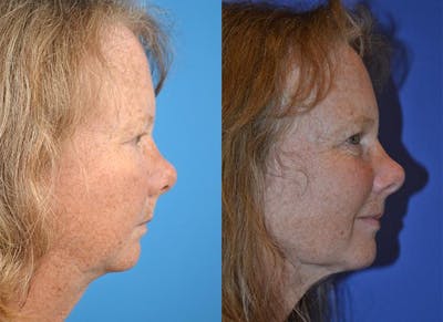 Chin Augmentation Before & After Gallery - Patient 122405541 - Image 1