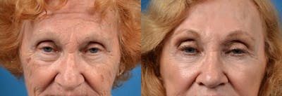 Brow Lift Before & After Gallery - Patient 122405542 - Image 1