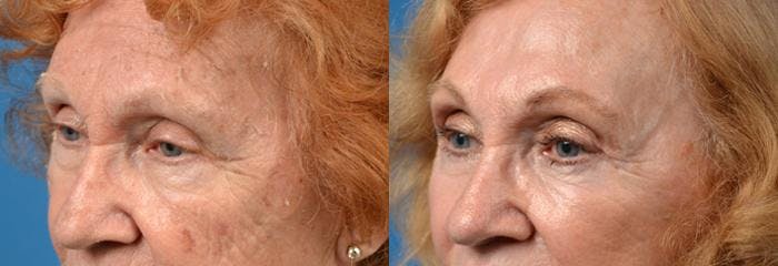 Brow Lift Before & After Gallery - Patient 122405542 - Image 2