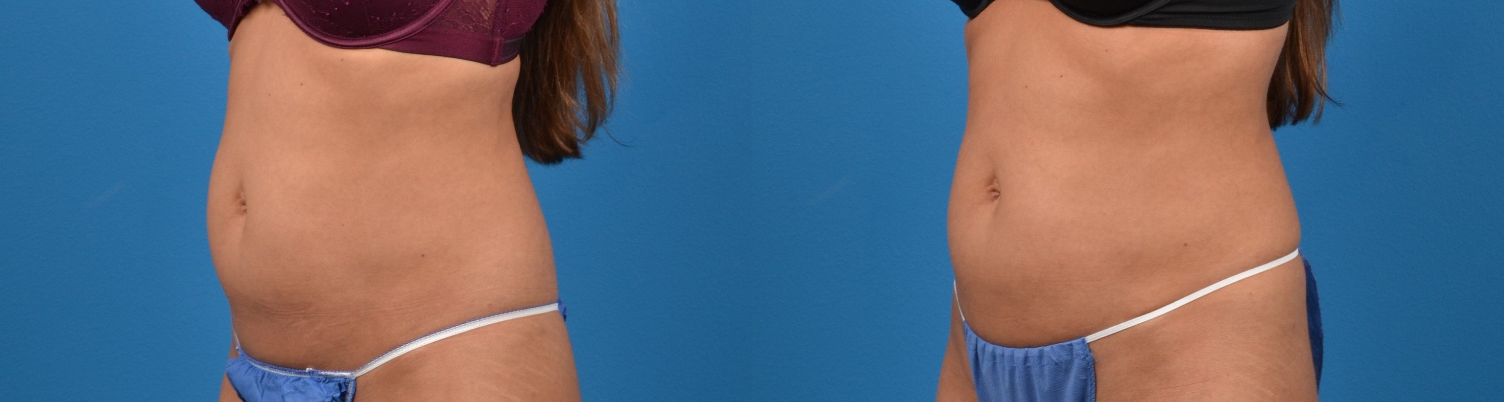 CoolTone Before & After Gallery - Patient 122405544 - Image 2