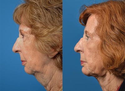 Chin Augmentation Before & After Gallery - Patient 122405546 - Image 1