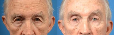 Brow Lift Before & After Gallery - Patient 122405545 - Image 1