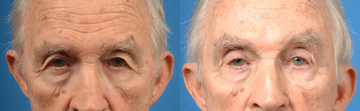 Brow Lift Before & After Gallery - Patient 122405545 - Image 1