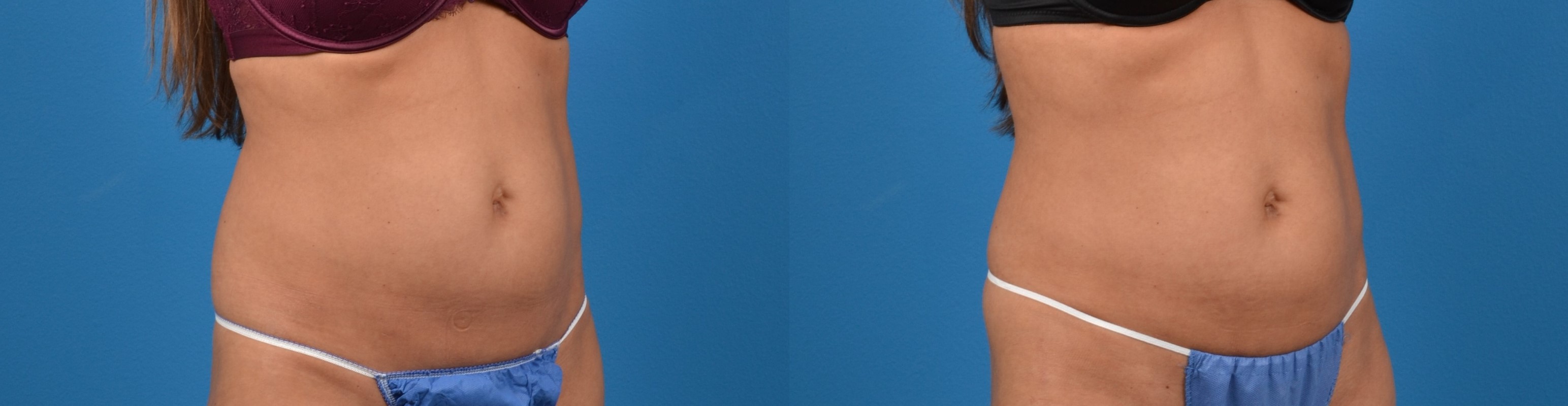 CoolTone Before & After Gallery - Patient 122405544 - Image 3