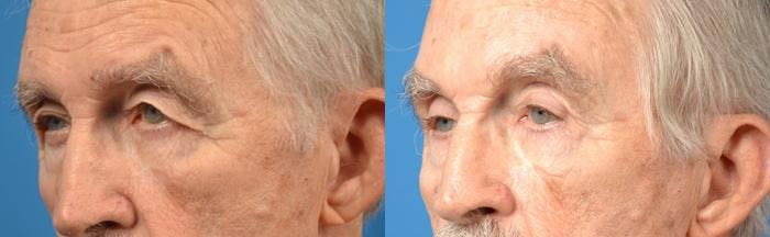 Brow Lift Before & After Gallery - Patient 122405545 - Image 2